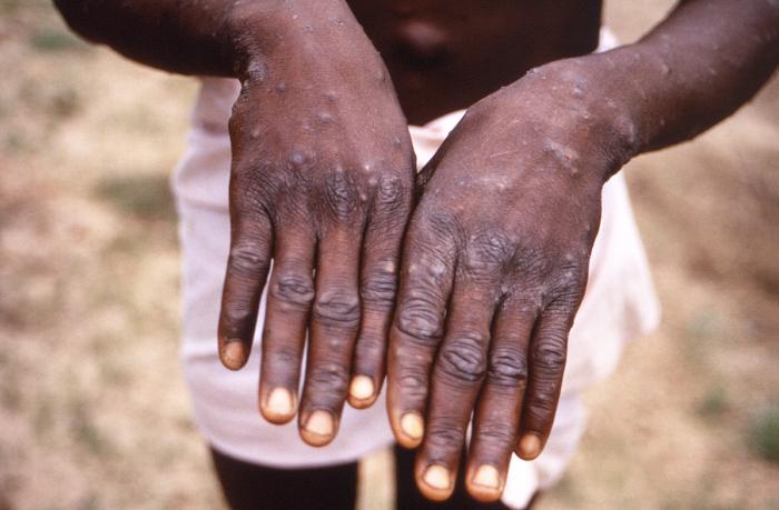 This 1997 image was created during an investigation into an outbreak of monkeypox, which took place in the Democratic Republic of the Congo (DRC), formerly Zaire, and depicts the dorsal surfaces of the hands of a monkeypox case patient, who was displaying the appearance of the characteristic rash during its recuperative stage. Even in its stages of healing, note how similar this rash appears to be when compared to the recuperative rash of smallpox, also an Orthopoxvirus. Image from Creative Commons.